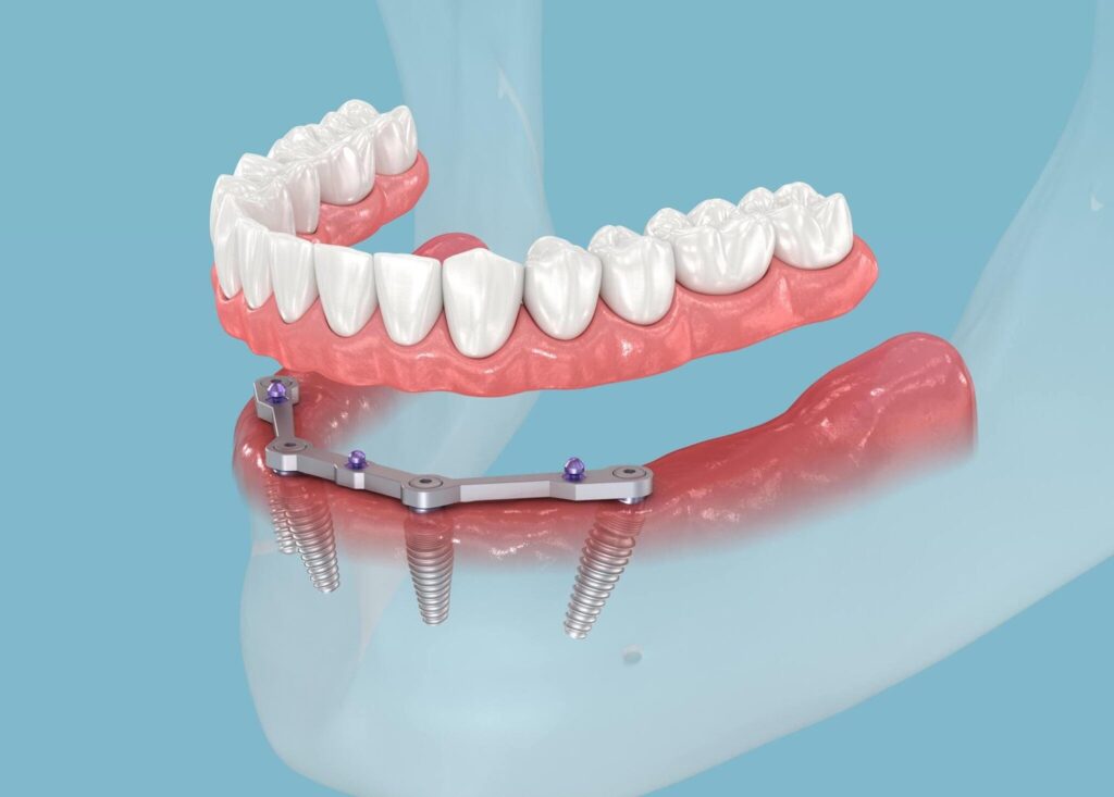 All about Dental Implants: Secure Root Replacements for Missing Teeth the Journey of Dental Implants