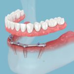 All about Dental Implants: Secure Root Replacements for Missing Teeth the Journey of Dental Implants