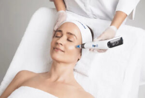 microneedling Edmonton Alberta