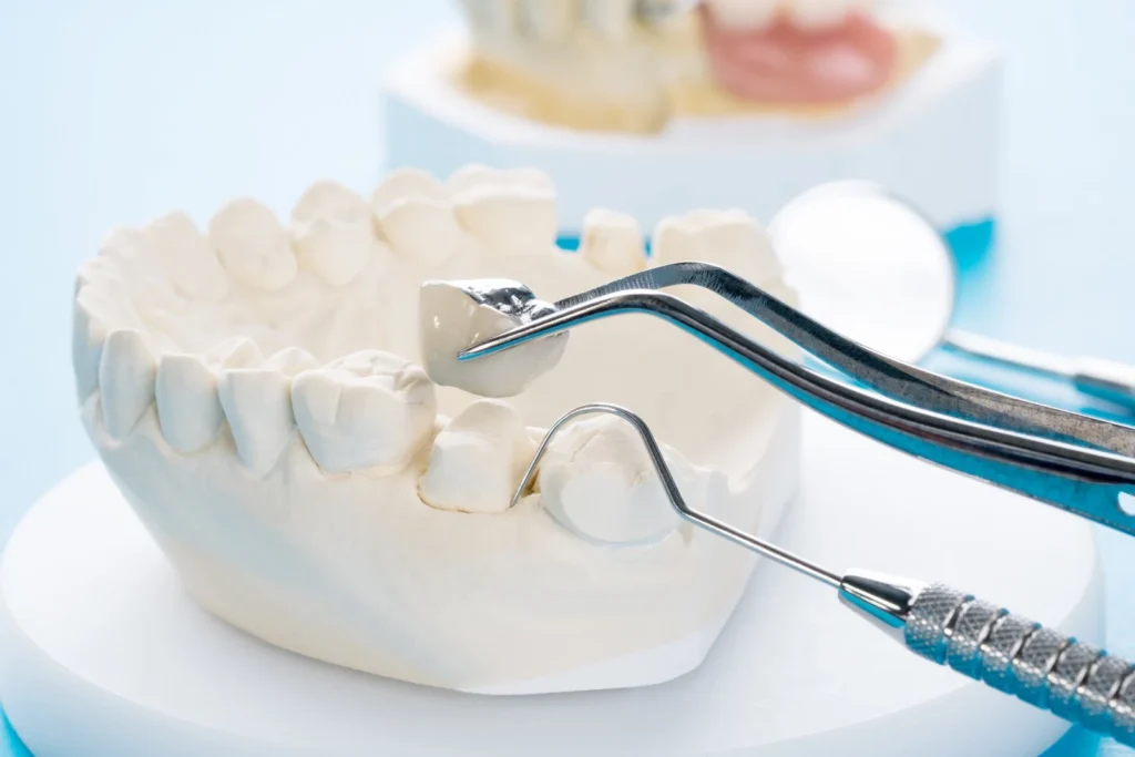 Dental Crowns Holly Springs NC for Stronger and Healthier Teeth