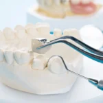 Dental Crowns Holly Springs NC for Stronger and Healthier Teeth