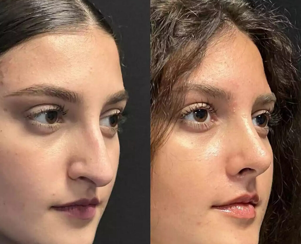 Rhinoplasty in Dubai