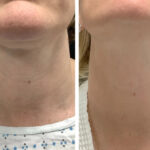 Best Aesthetic Clinic in dubai for Premium Radiofrequency Microneedling Care