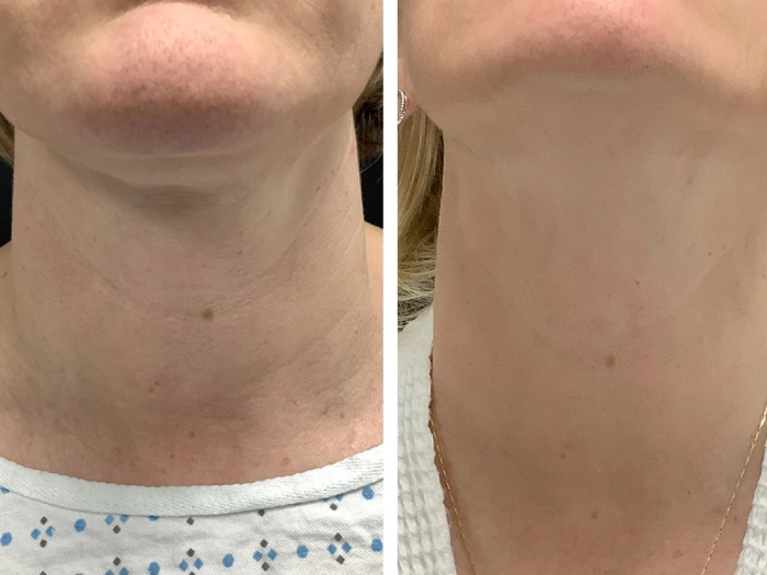 Best Aesthetic Clinic in dubai for Premium Radiofrequency Microneedling Care