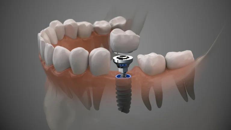 Replace Missing Teeth with Quality Dental Implants Pell City AL