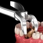 Tooth Extraction Explained: From Procedure to Recovery and Methods of Extractions in Trussville AL