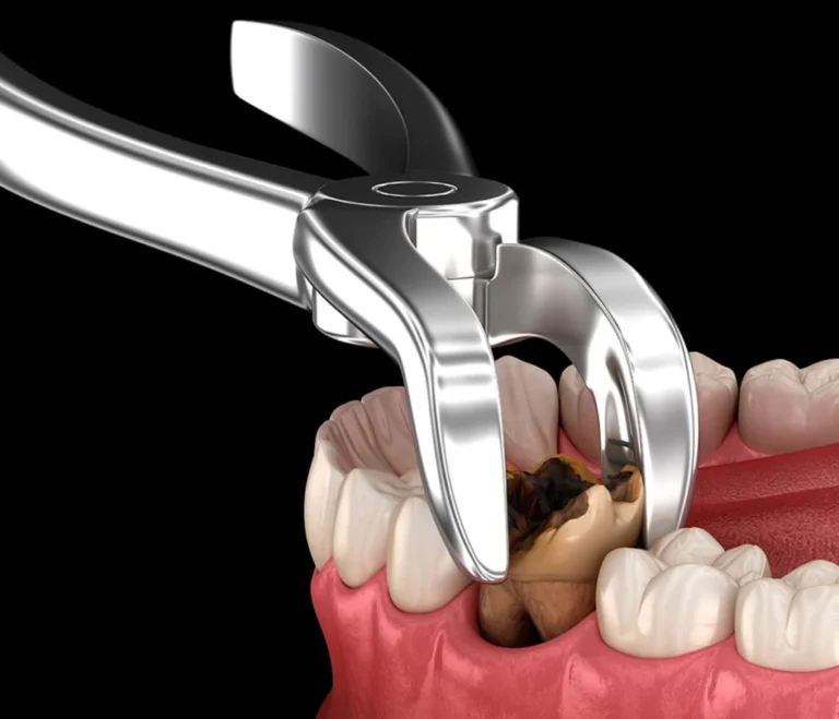 Tooth Extraction Explained: From Procedure to Recovery and Methods of Extractions in Trussville AL