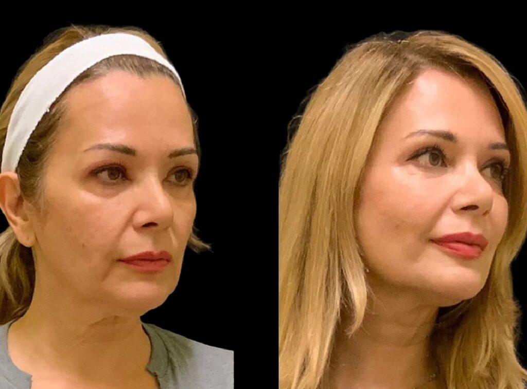 cheek fillers in dubai