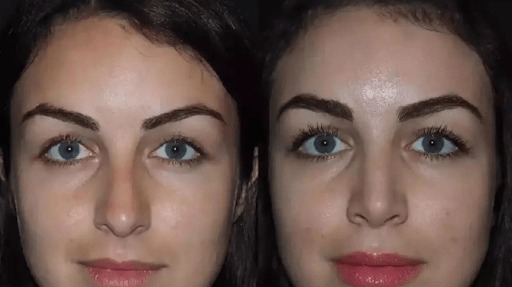 rhinoplasty in Dubai