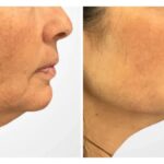 Best Doctors in Dubai Perform Thread Lift Procedures for Youthful Skin Appearance