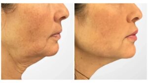 Best Doctors in Dubai Perform Thread Lift Procedures for Youthful Skin Appearance