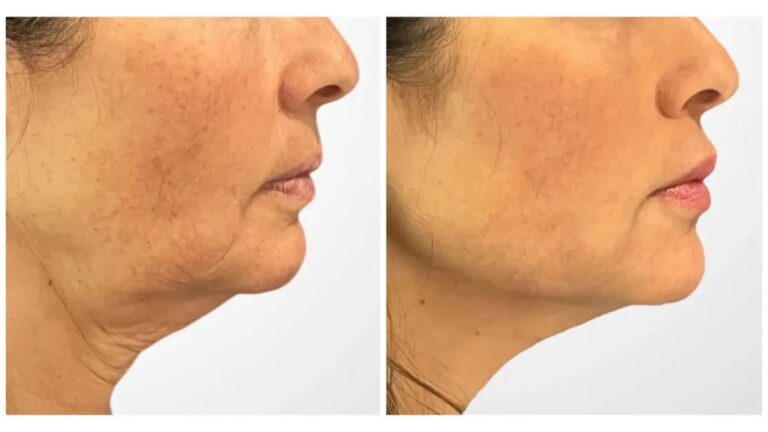 Best Doctors in Dubai Perform Thread Lift Procedures for Youthful Skin Appearance