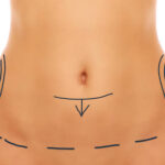 Abdominoplastie à Paris