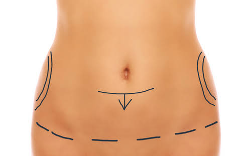 Abdominoplastie à Paris