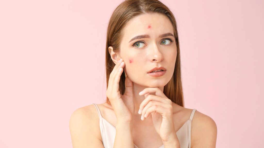 Acne-in-Adults-2