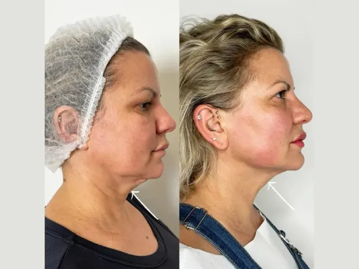 Endolift in dubai for Personalized Skin Firming and Facial Enhancement