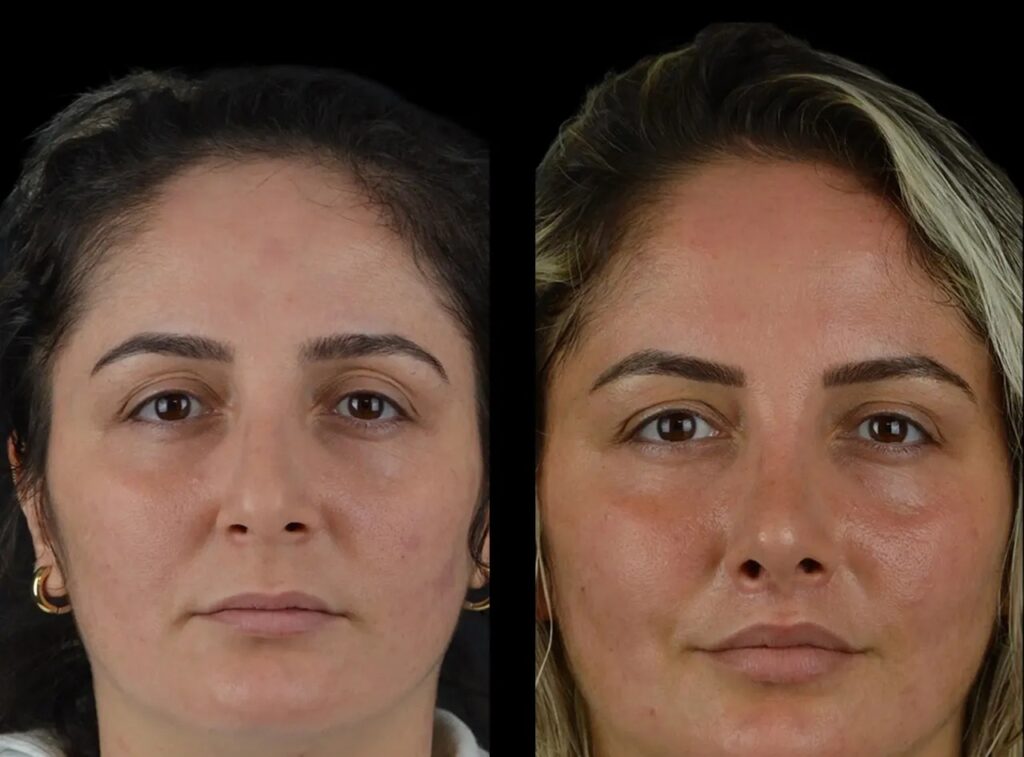 Cheeck Fillers in dubai