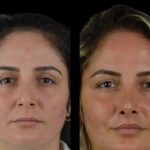 Cheeck Fillers in dubai