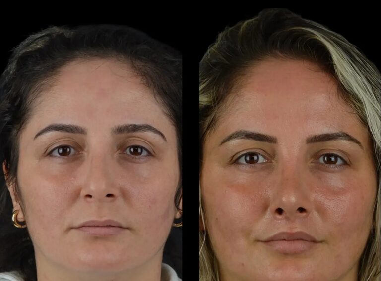 Cheeck Fillers in dubai