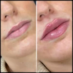 Dermal Fillers in Dubai