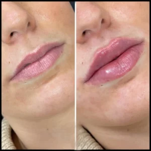 Dermal Fillers in Dubai