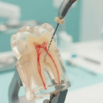 Root Canal Cost Sonipat: What Patients Actually Pay and Why Prices Vary So Much