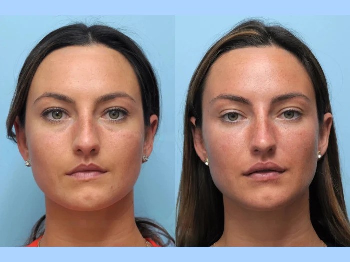 Best Plastic Surgeon in Dubai: Youthful Facial Appearance Through Modern Thread Lift