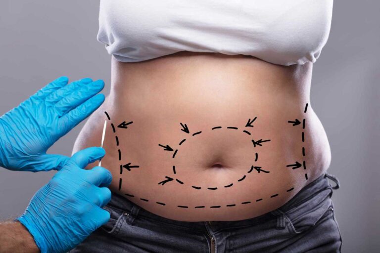 tummy-tuck-in-dubai